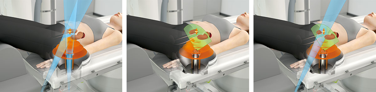 In-line localization with X-ray fluoroscopy (AP/PA) / In-line ultrasound localization / Simultaneous X-ray and ultrasound monitoring 
